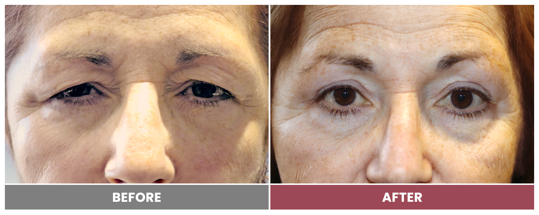 Upper Blepharoplasty - Case 45